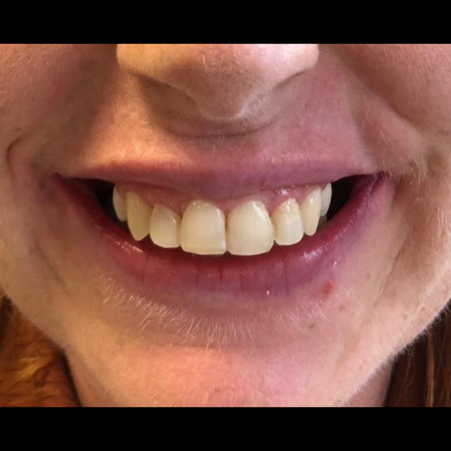 6 month braces - after - 3Dental